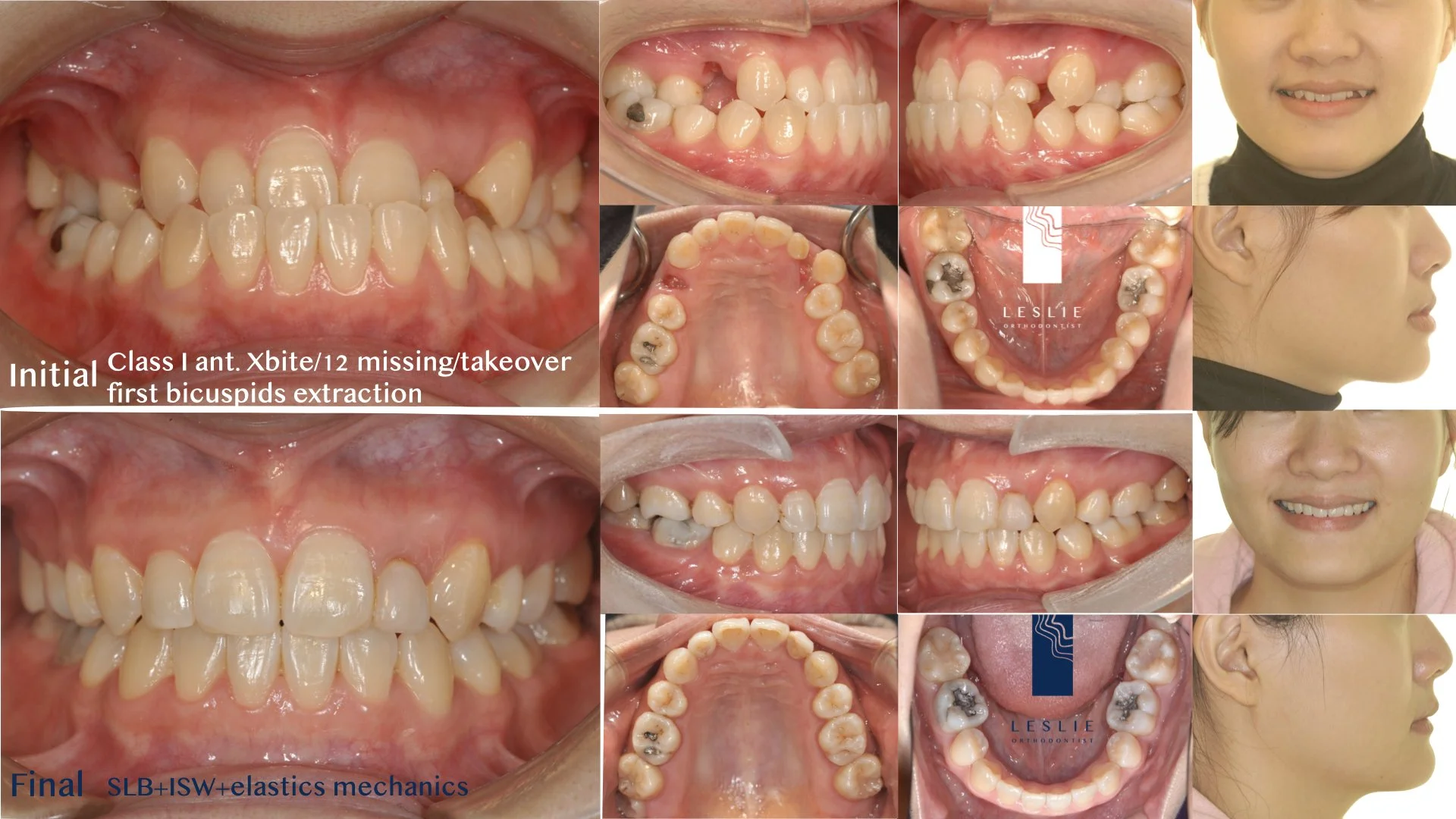 anterior crossbite.005.jpeg
