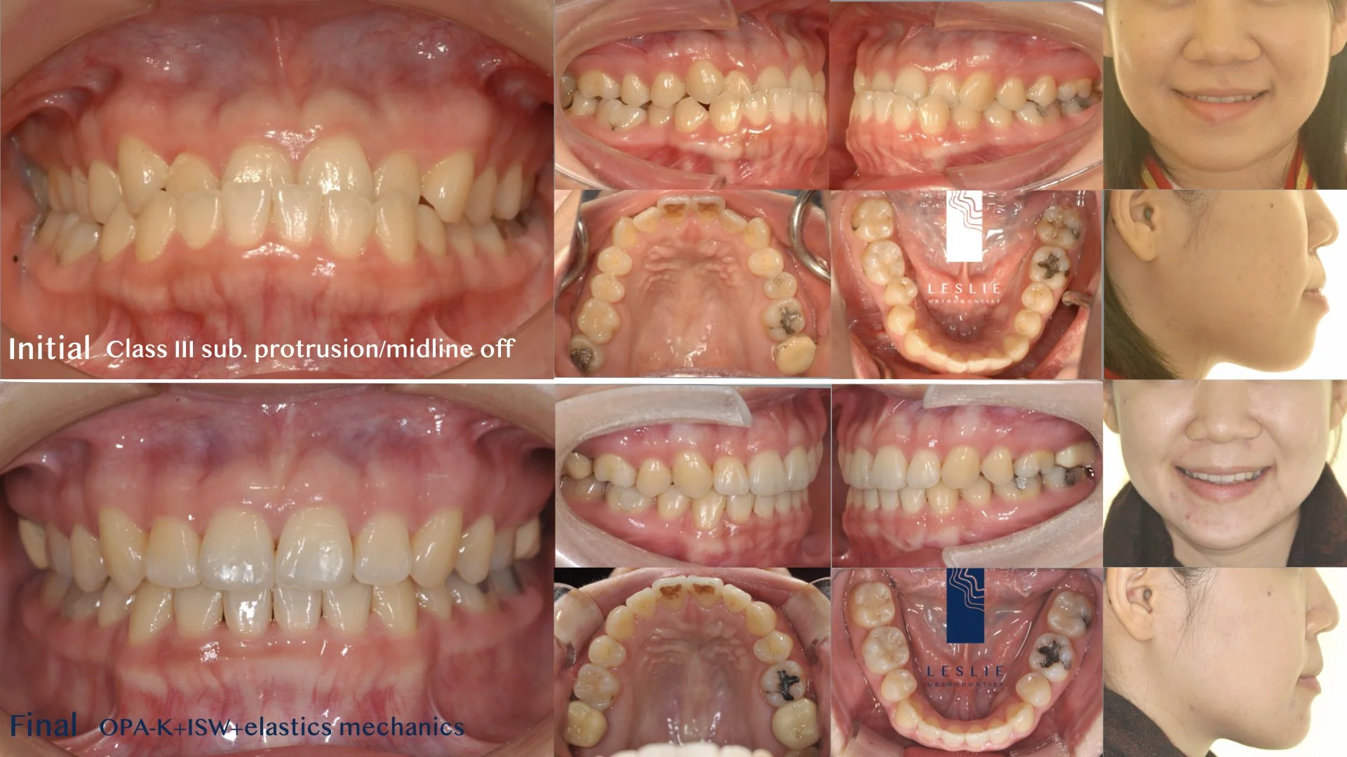 anterior crossbite.006.jpeg