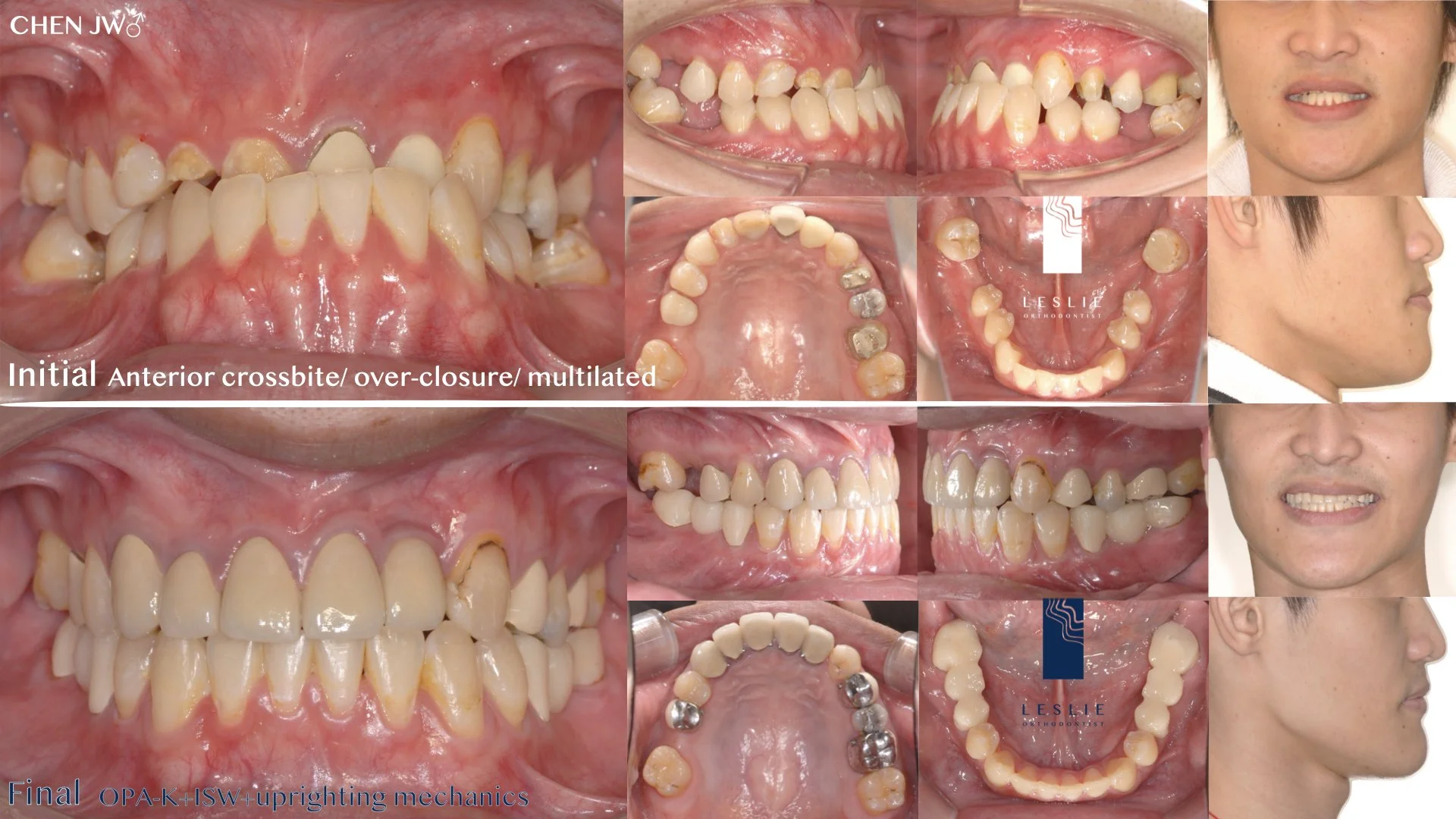 anterior crossbite.007.jpeg