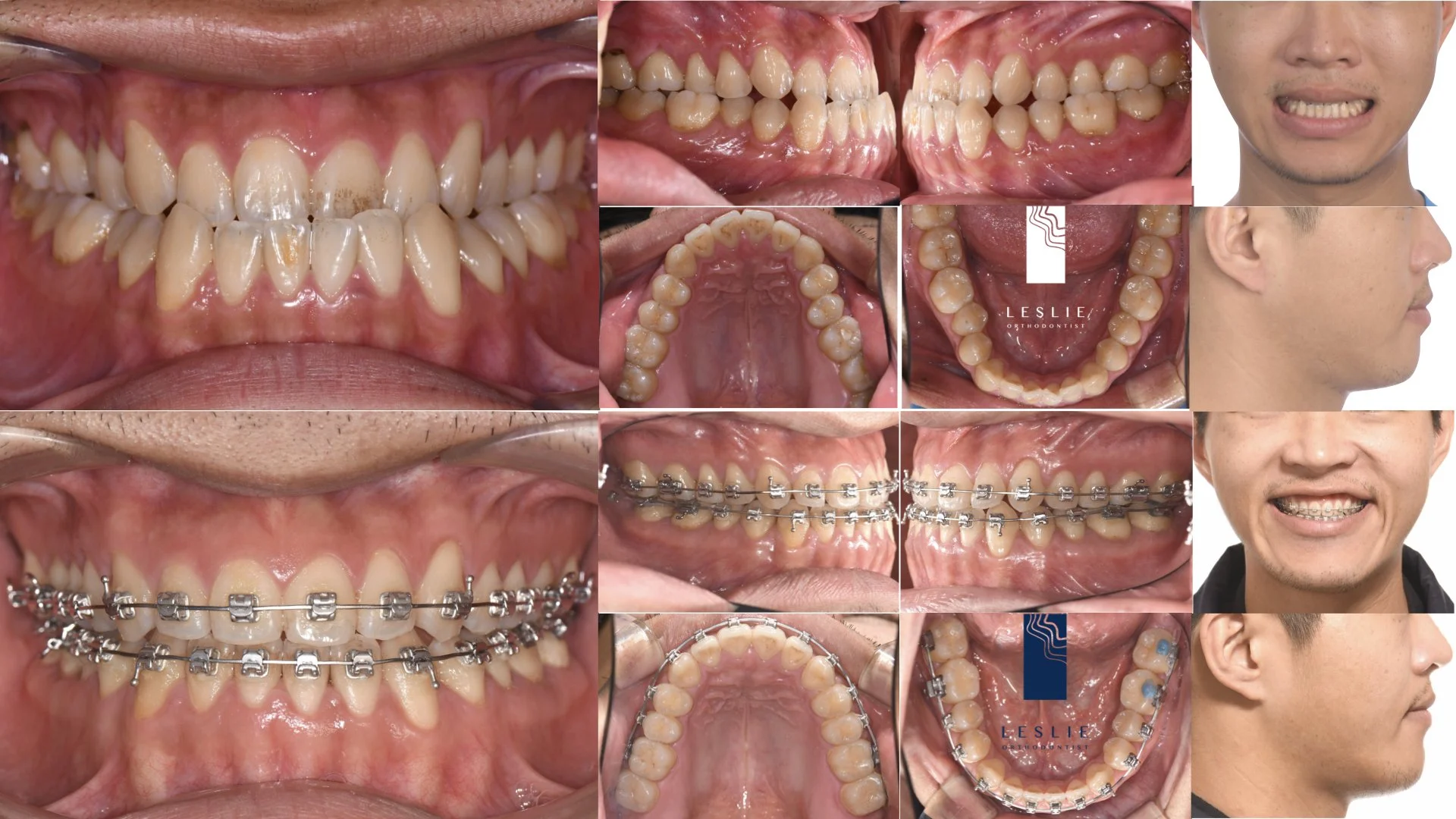 anterior crossbite.008.jpeg