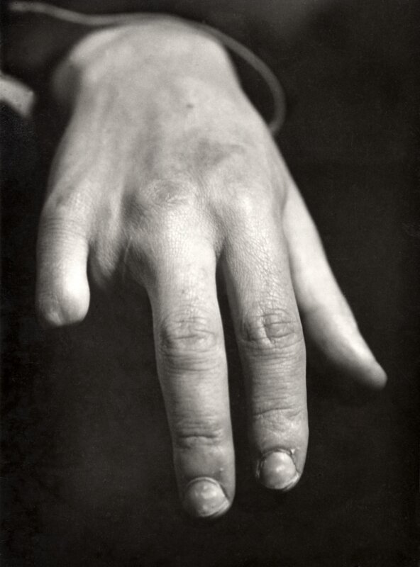  Verminkte hand, voordat deze een nieuw aangezicht zal krijgen door prothesen van professor Henning. Oostenrijk, 1937. 