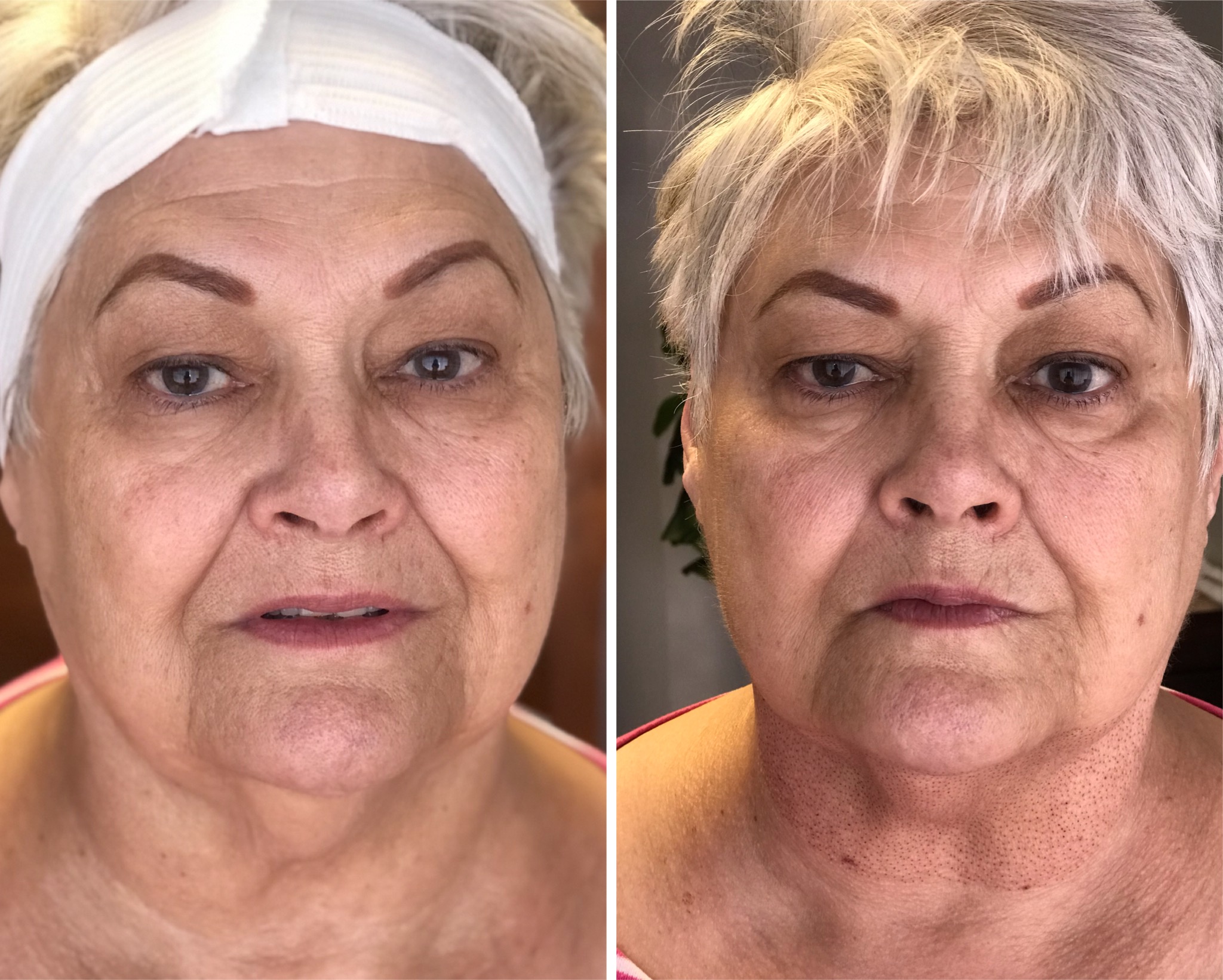 Immediately after treatment