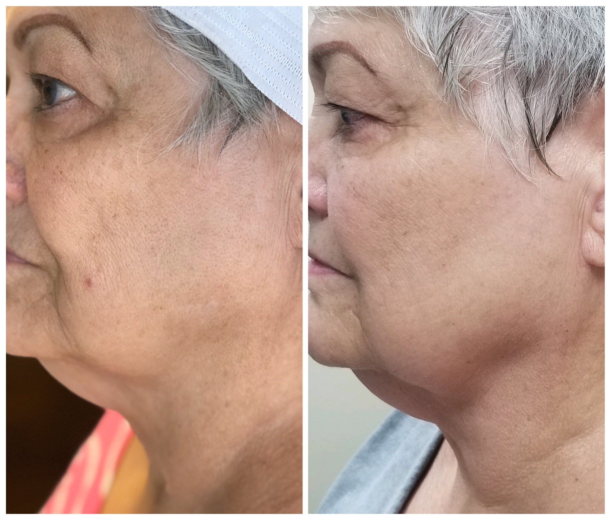 Jowls and Under Chin Firming