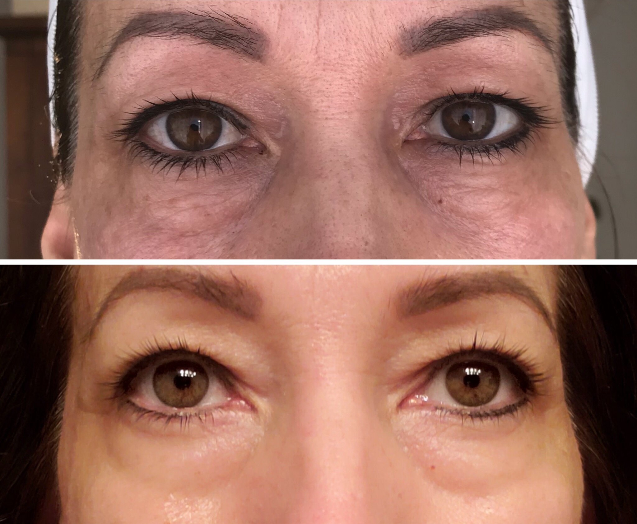 Lift Eyes and Reduce Wrinkles