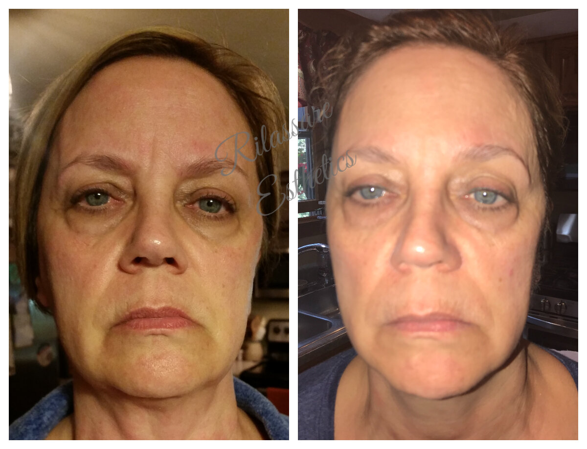 Firming Jowls and Frown Lines