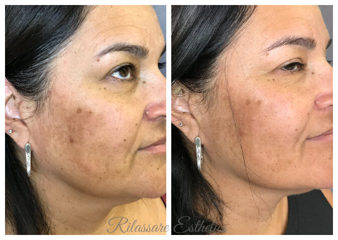 Melasma and Firming