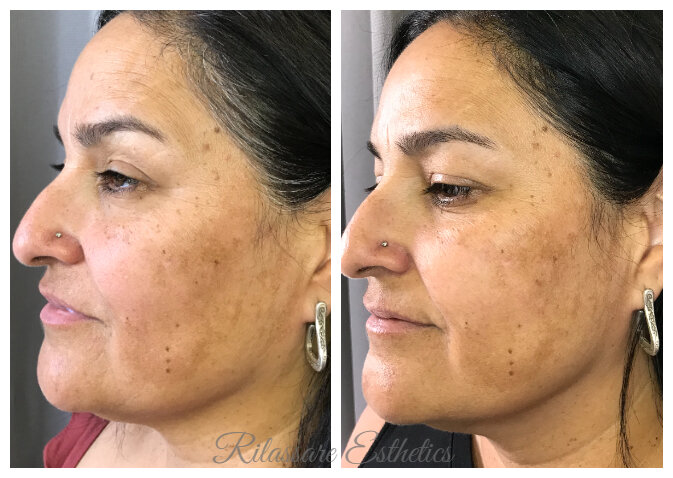 Melasma and Firming