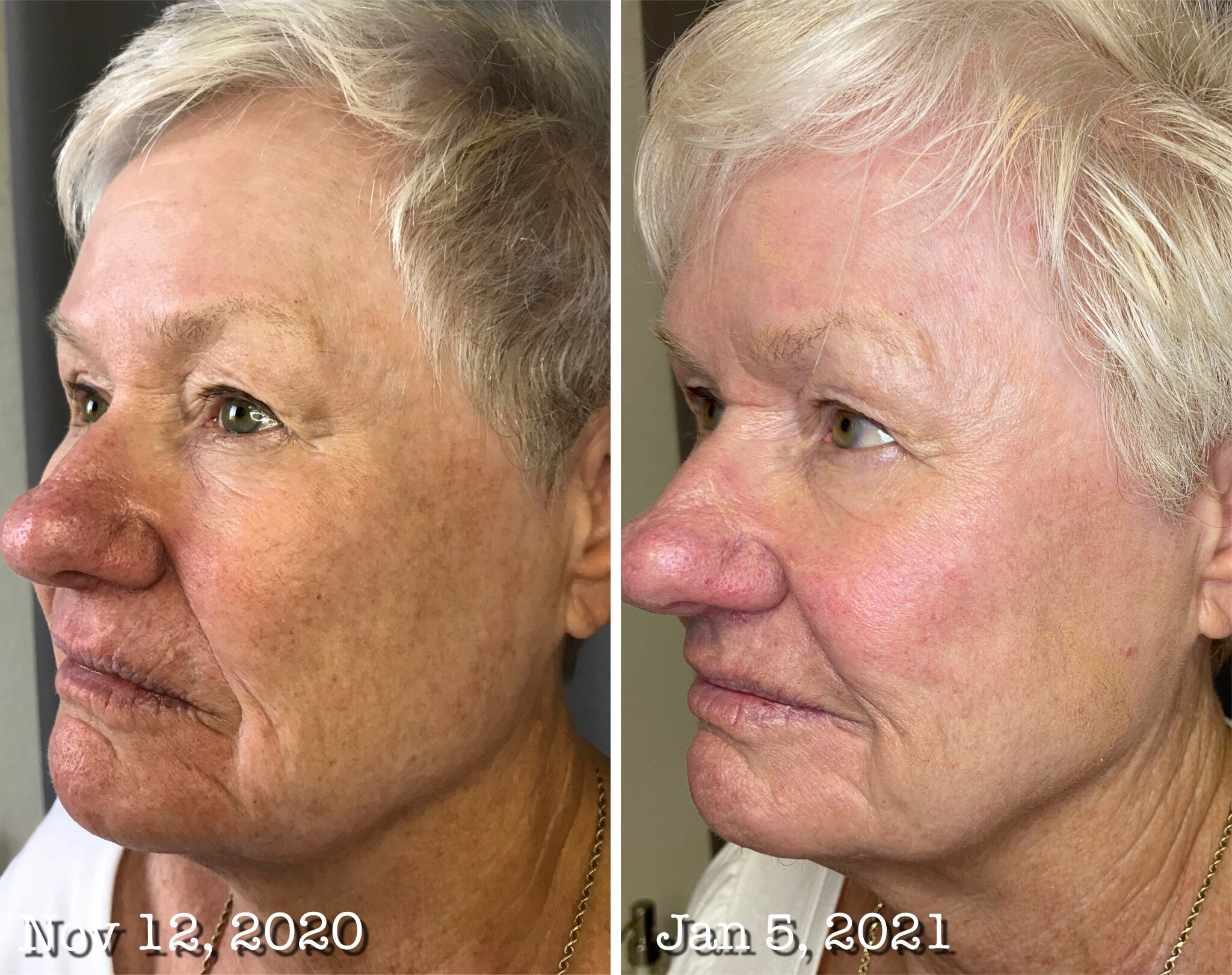 Lower Face Firming