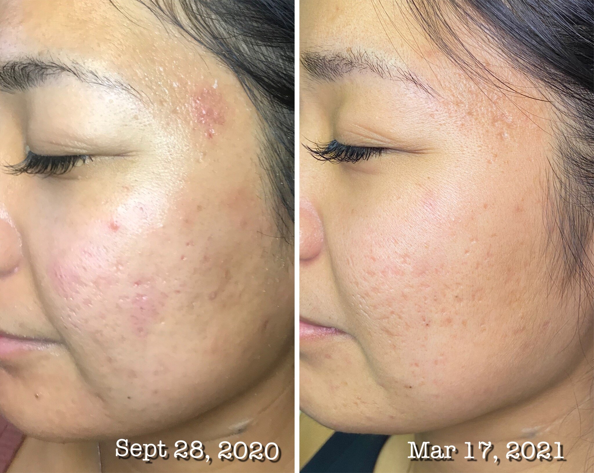 Reduce Acne Scarring