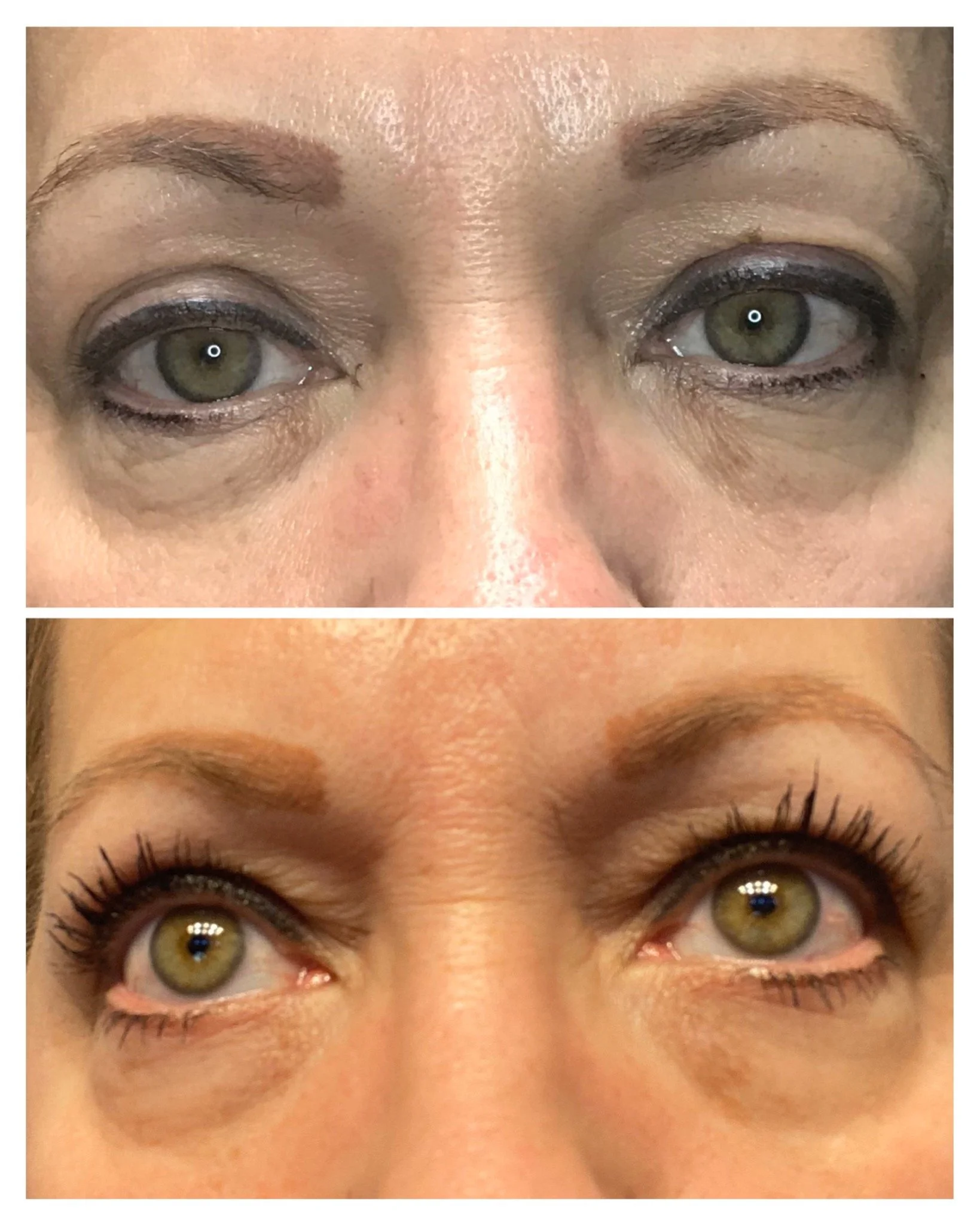 Fibroblast Skin Rejuvenation-3.jpg