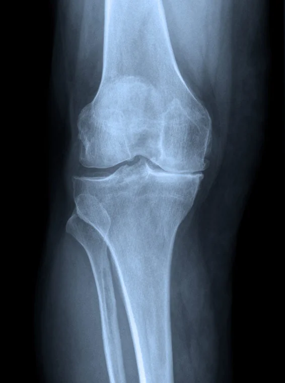 Knee Arthroscopy Knee Ligament Reconstruction Knee Anterior Cruciate Ligament Reconstruction (ACL) Knee Patellofemoral Stabilisation/Realignment Knee Osteotomies Knee Replacement Knee Replacement Partial (Unicompartmental and Patellofemoral Replacement) Knee Replacement Revision