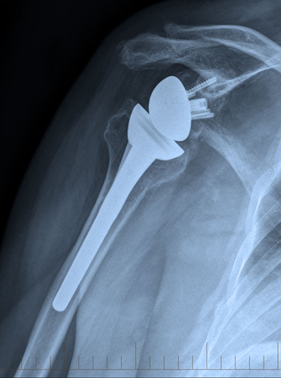 Shoulder Arthroscopic and Open Stabilisation for Recurrent Dislocation Shoulder Arthroscopic Bursectomy, Decompression and Rotator Cuff Repair Shoulder Arthroscopic SLAP Tear Repair/ Biceps Tenodesis Shoulder Replacement Anatomic and Reverse