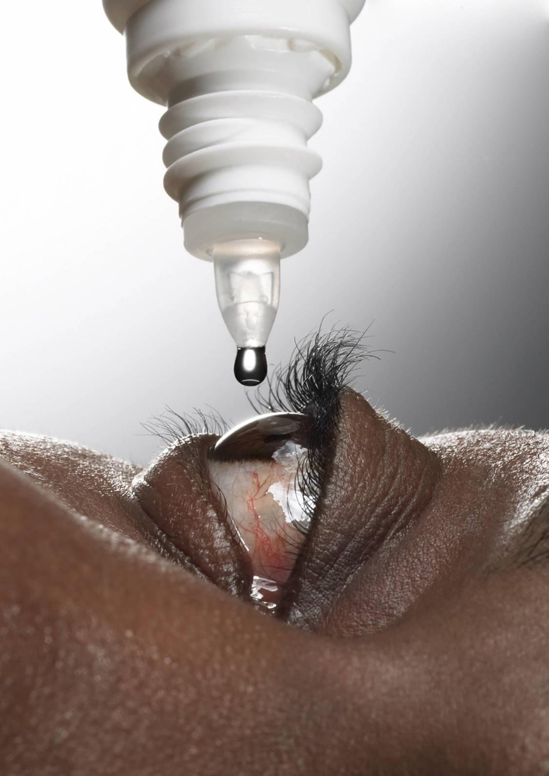 Close-up of a person receiving eye drops from a white bottle with a dropper, focusing on the eye and eyelashes.