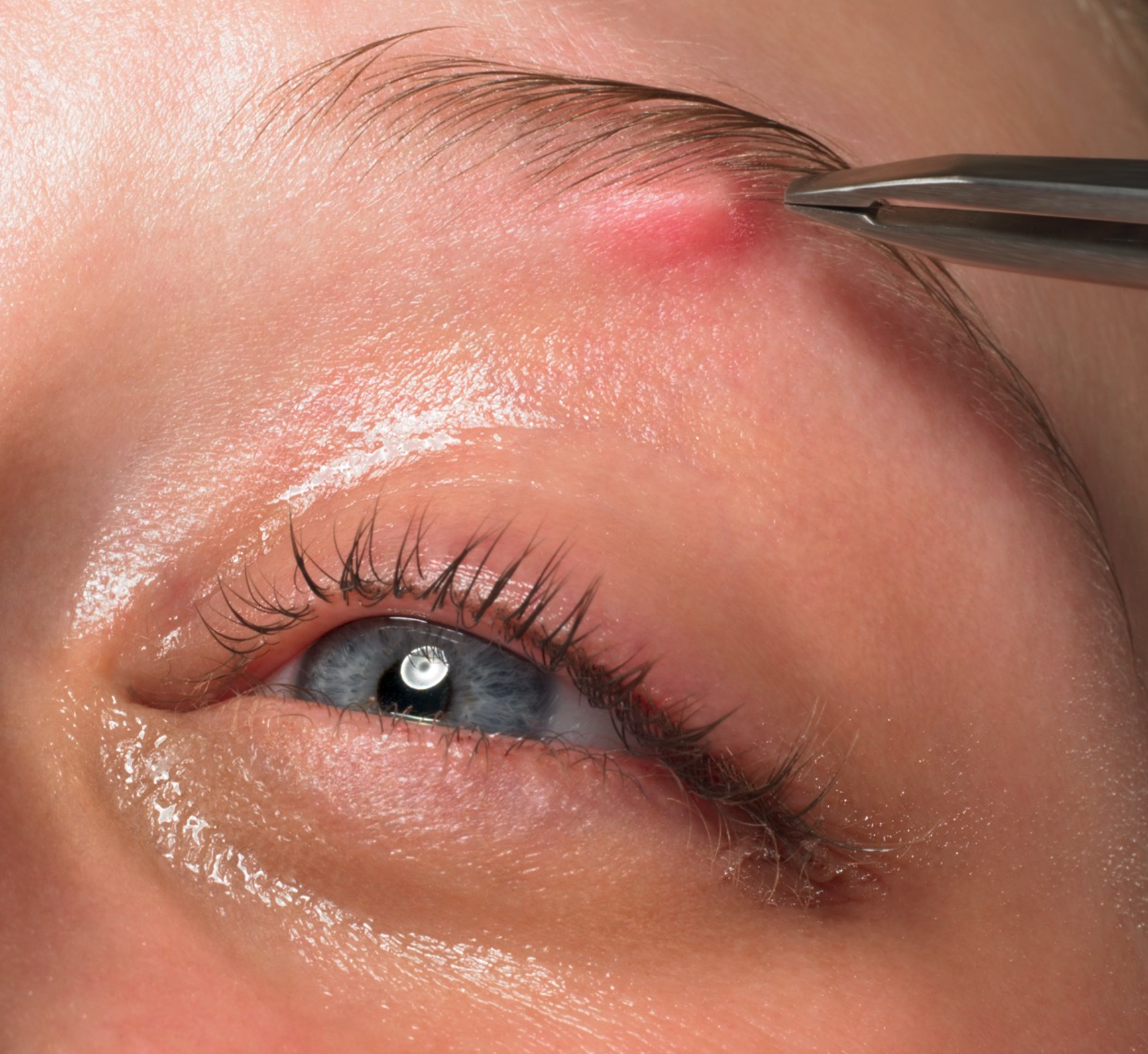 Close-up of a person's eye with a small red bump on the eyelid, a pair of tweezers holding the bump, wet skin around the eye, blue iris, and long eyelashes.