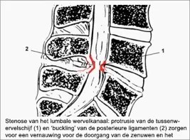 Spinale stenose1.jpg