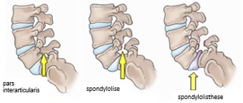 spondylo2.png