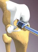 Osteochondrale allogreffe transplant