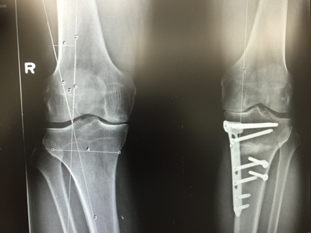 Onvoorziene omstandigheden douche steekpenningen Osteotomie knie — Orthokliniek