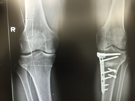 Fig. 1. Pre-operatieve berekening van exacte hoeveelheid correctiegraad, door bepaling van correctie van de mechanische assen door het been. Aan de andere knie is reeds eerder een opening wedge proximale tibia-osteotomie uitgevoerd.