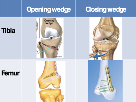 Fig. 3. Voorstelling van verschillende osteotomie-opties rondom de knie: opening wedge of closing wedge (kolommen), thv proximale tibia of distale femur (rijen)