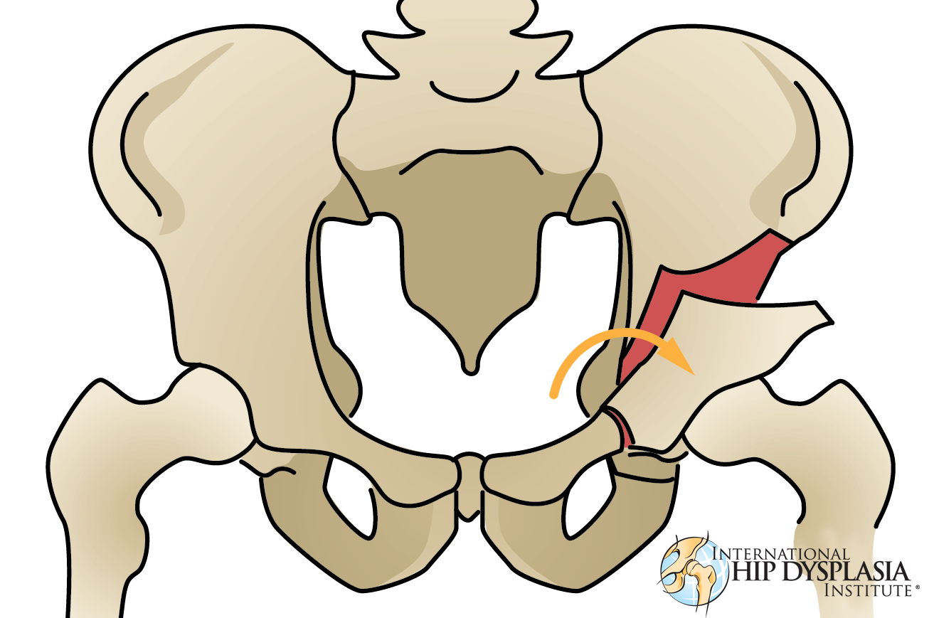 Source: IHDI (www.hipdysplasia.org)