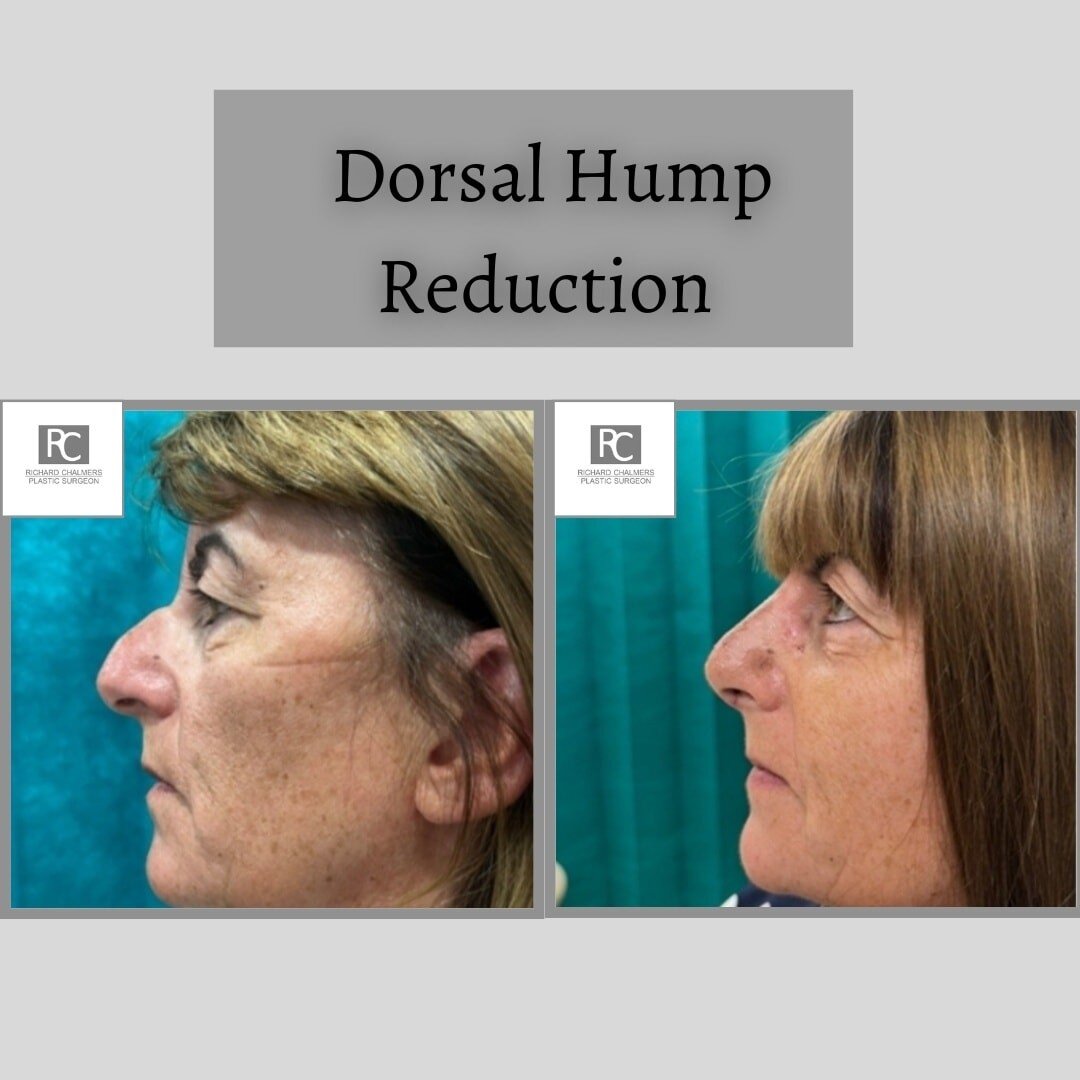GREAT EARLY RESULT FROM DORSAL HUMP REDUCTION! 👌

This patient is only 7 days post op following dorsal hump reduction surgery and her results are looking fabulous already.