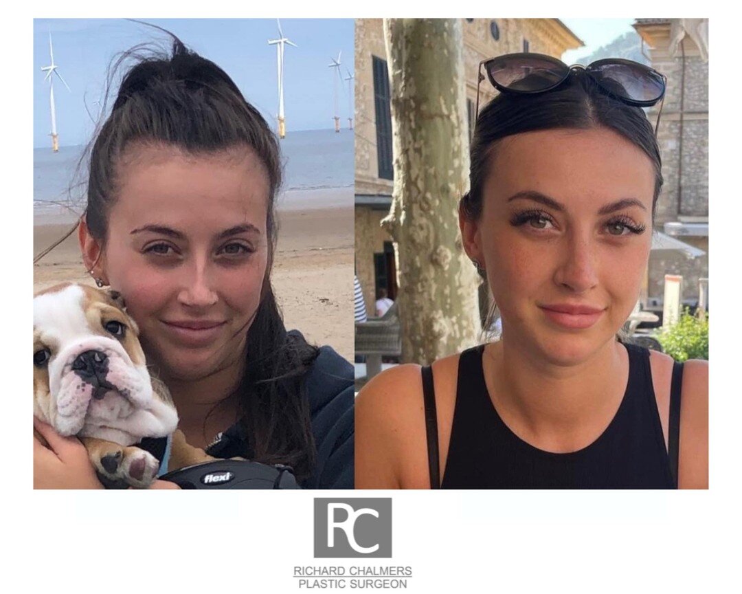 PATIENT BEFORE &amp; AFTER PHOTOGRAPHS 📸

Here is one of Mr Chalmers' lovely patients, who has sent us before and after photographs following her rhinoplasty surgery.

Along with the photographs this patient also sent us some amazing feedback.

&quo