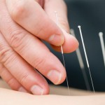 Acupuncture