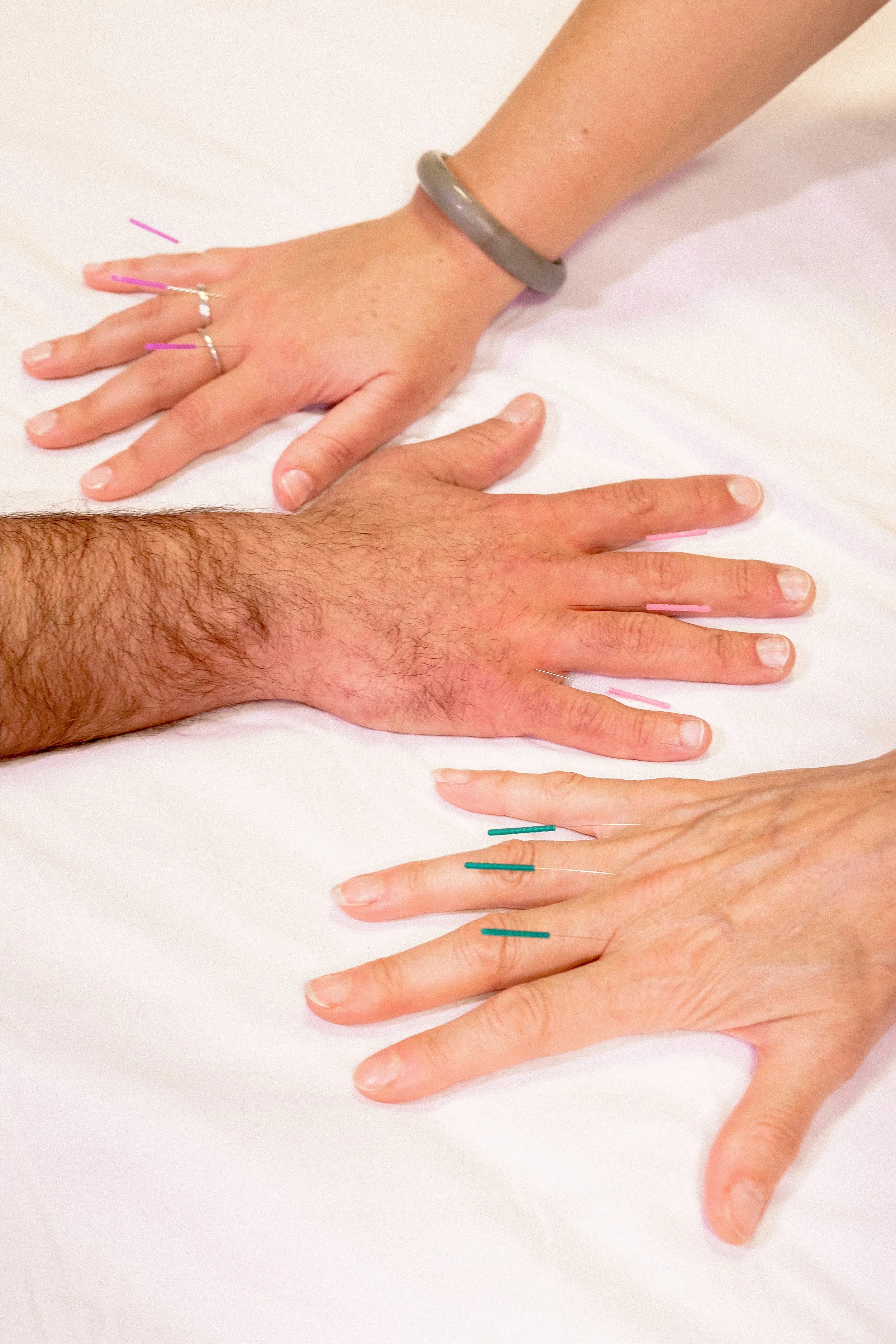 Best Acupuncture in Brooklyn