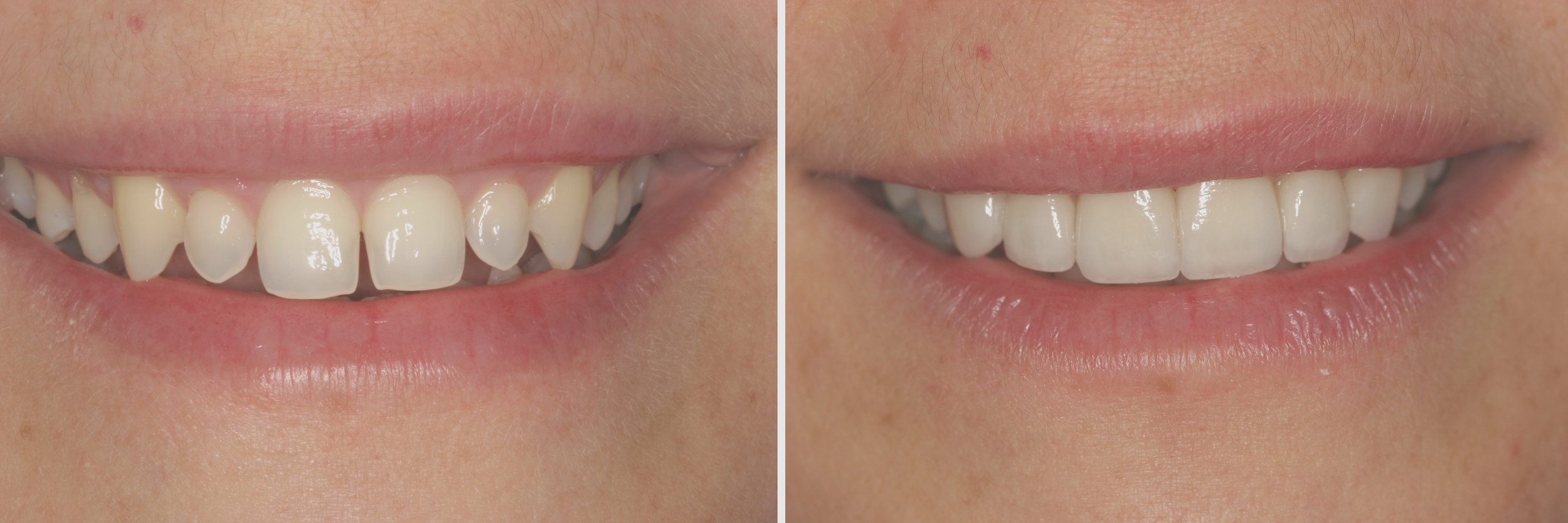 Before and After: Veneers