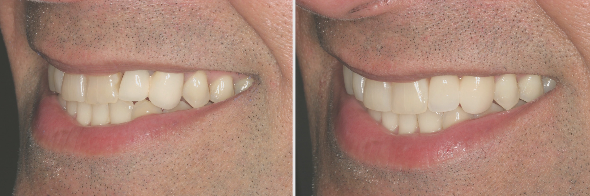 Before and After: Veneers