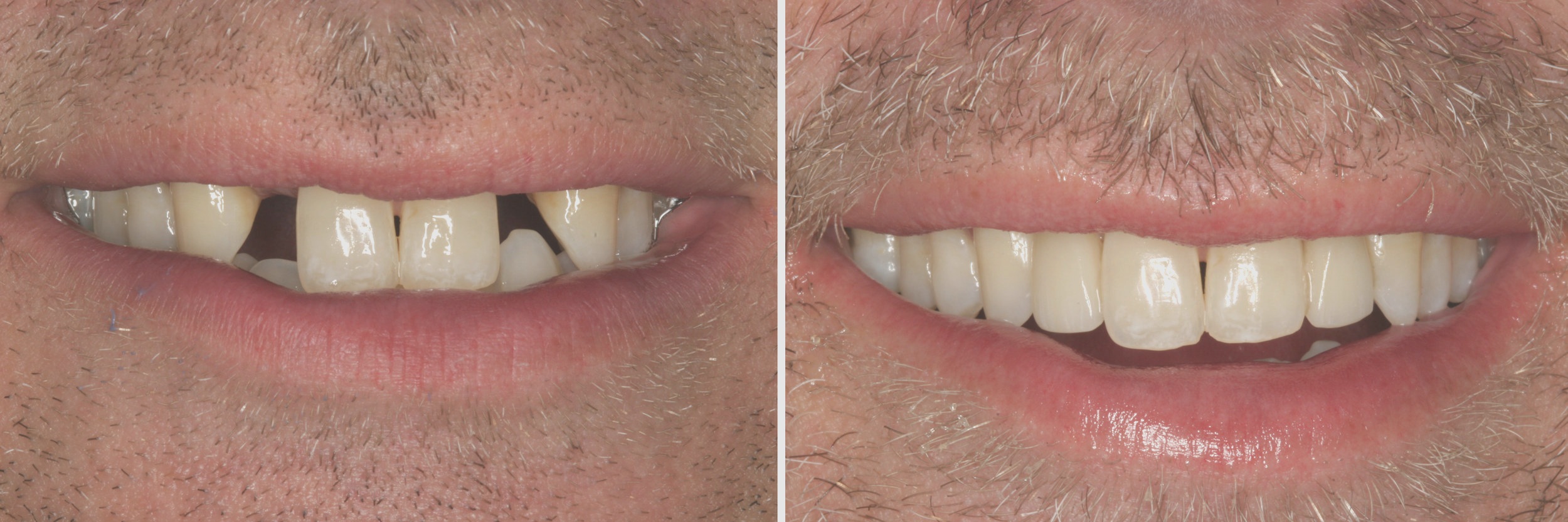 Before and After: Veneers