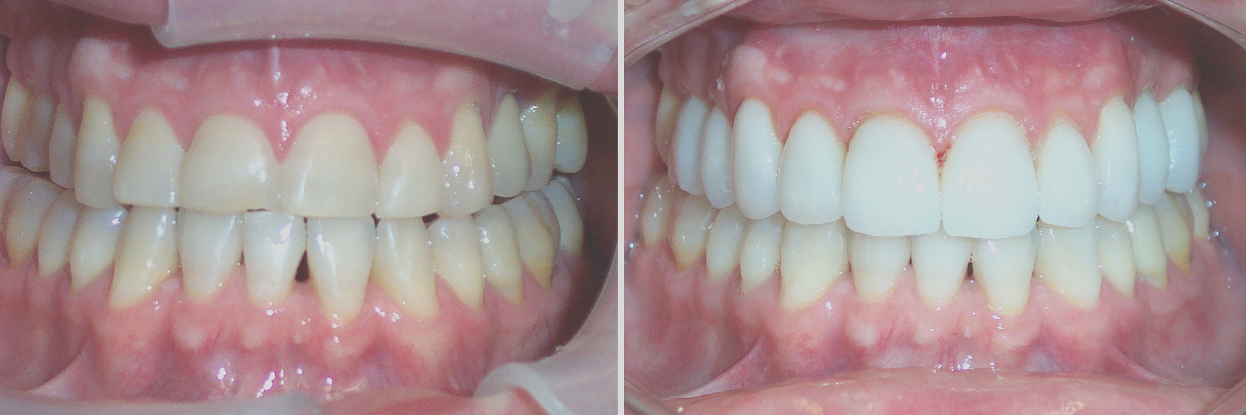 Before and After: Veneers