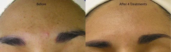 HydraFacial MD facial before and after.