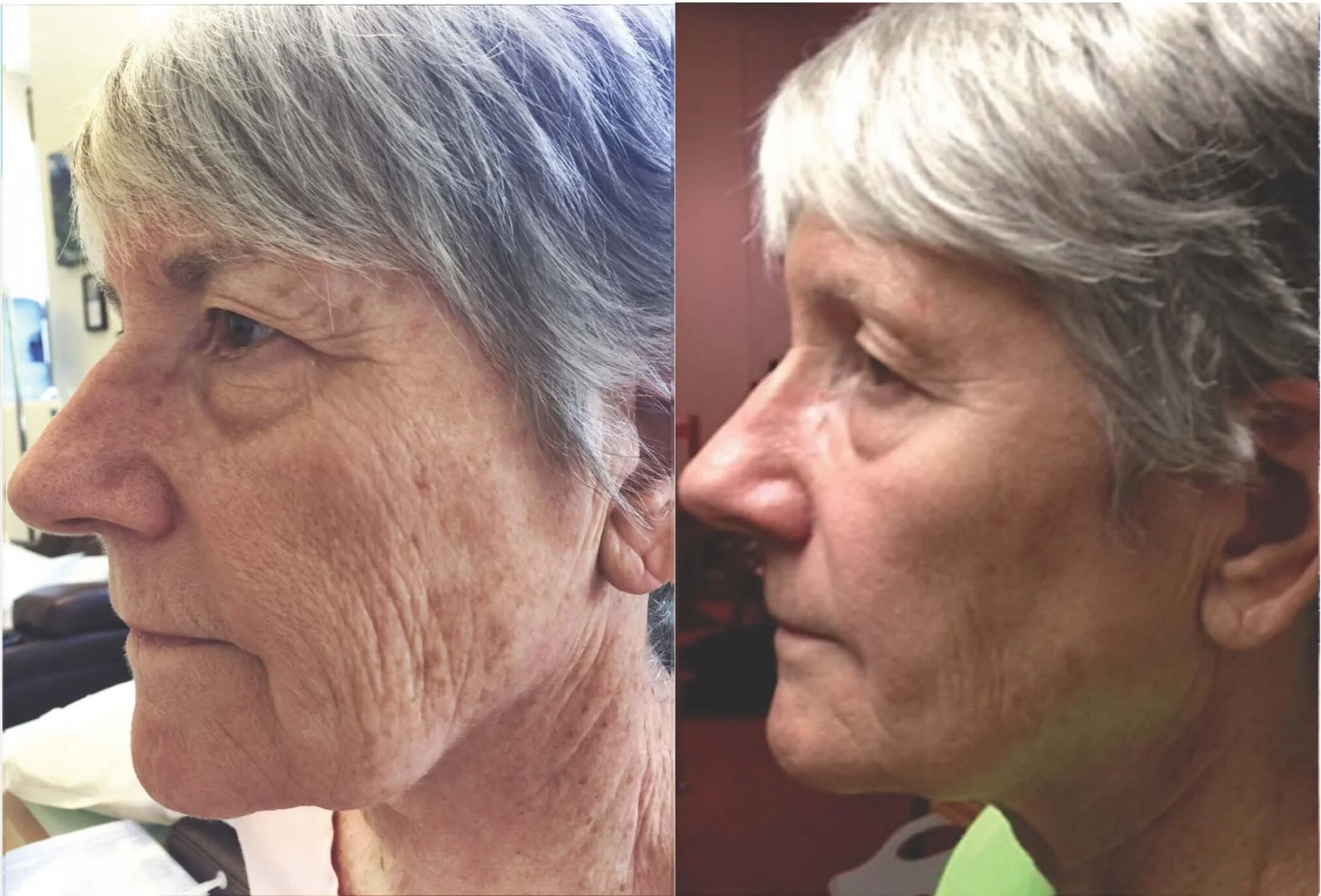 UltraCreme:  Before &amp; After