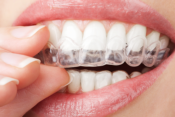 WHAT IS INVISALIGN?