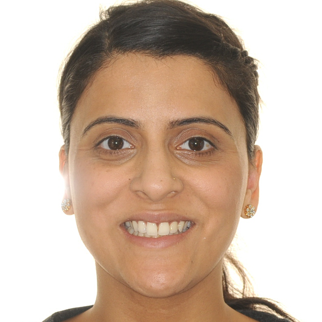 BEFORE &amp; AFTER: HOW TORQUING CHANGED THIS PATIENT'S FACIAL ALIGNMENT