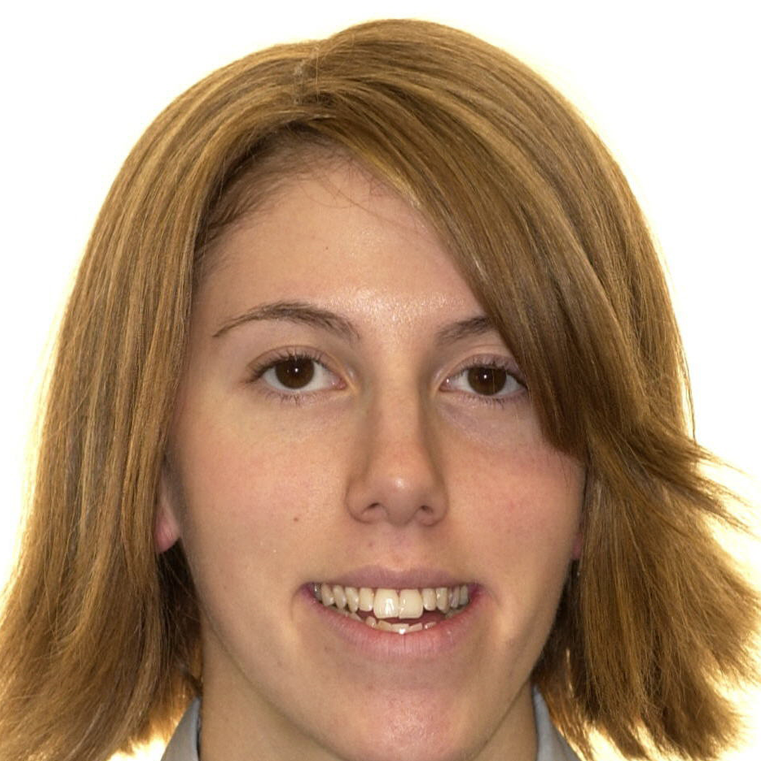 BEFORE AND AFTER: HOW JAW SURGERY &amp; INVISALIGN IMPROVED THIS PATIENT'S FACIAL ALIGNMENT