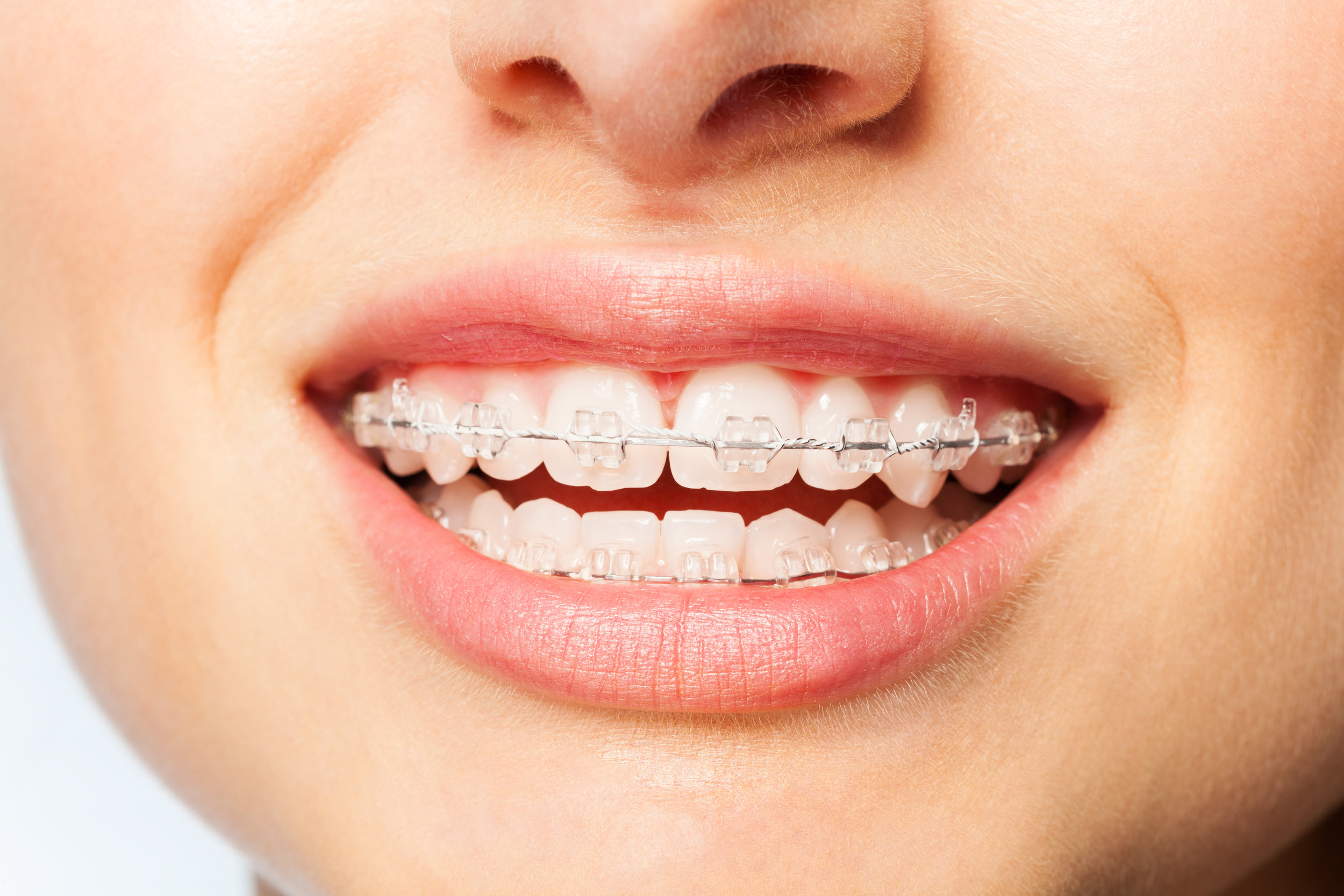 Clear Braces Invisible Braces — Lemchen Salzer Orthodontics Park