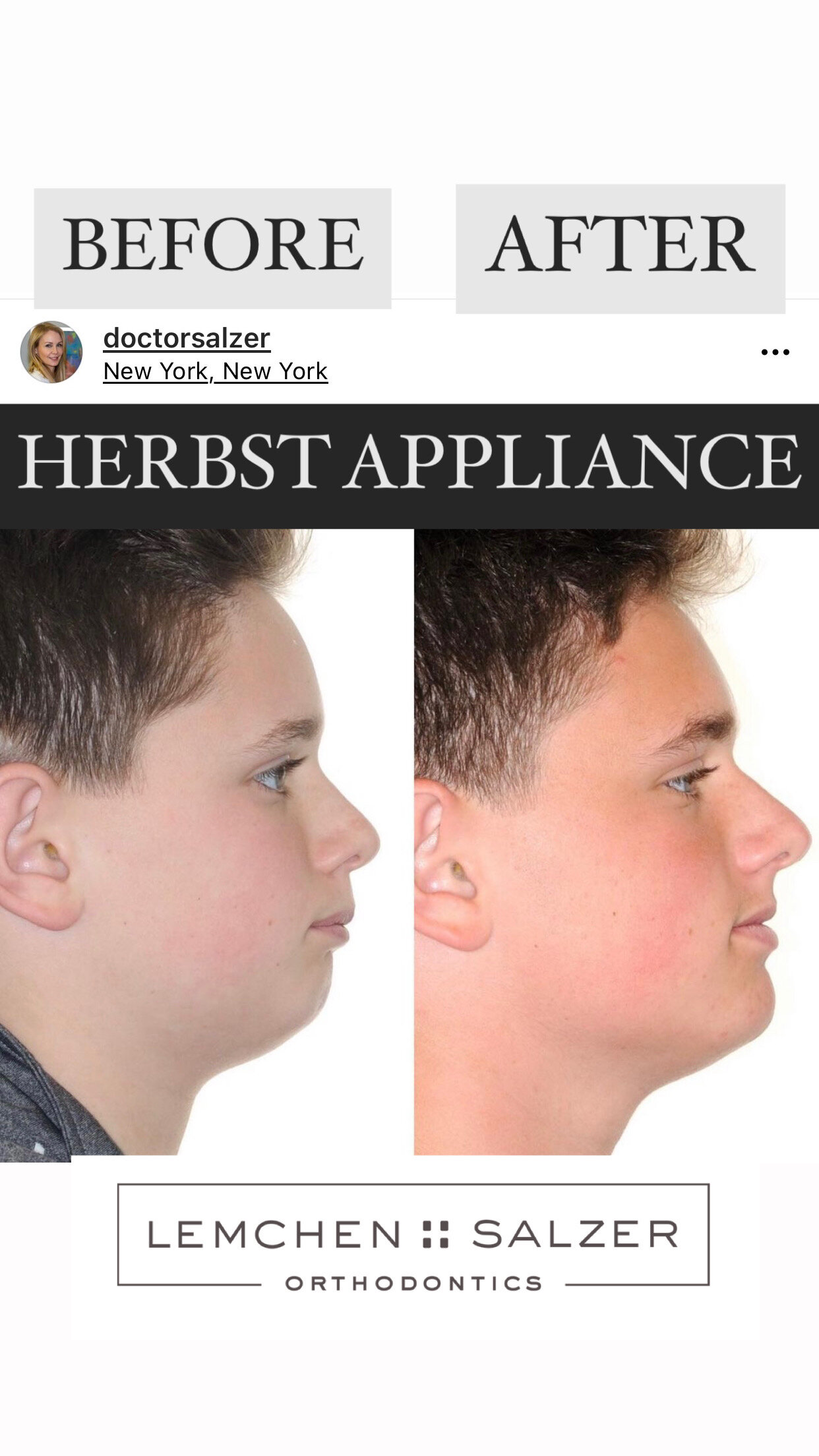 What is a Herbst Appliance?