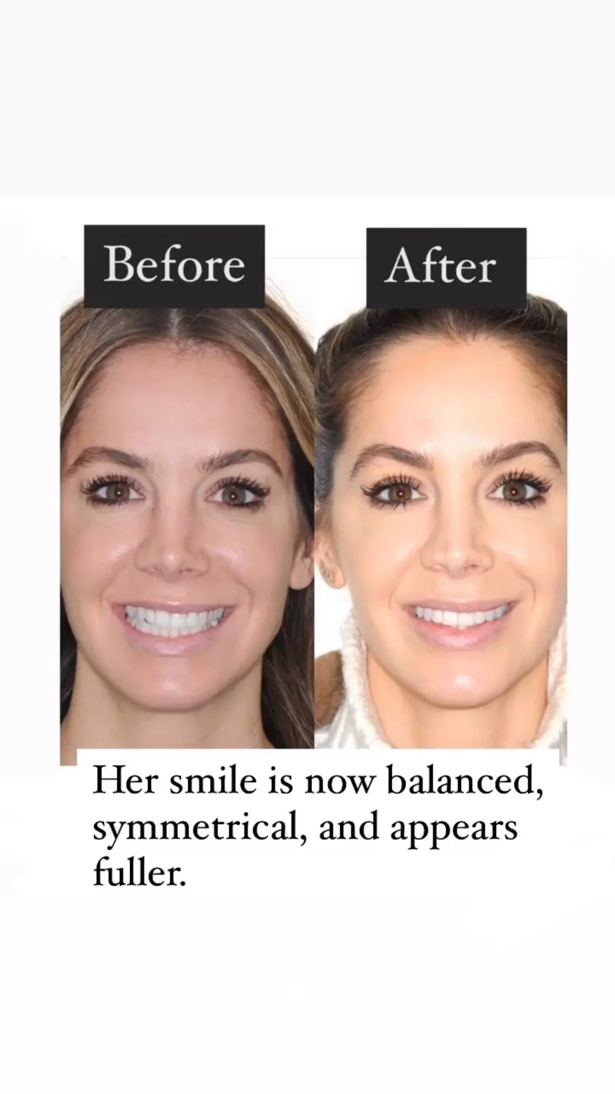 How We Balanced and Enhanced a Beautiful Smile That Tilted to One Side