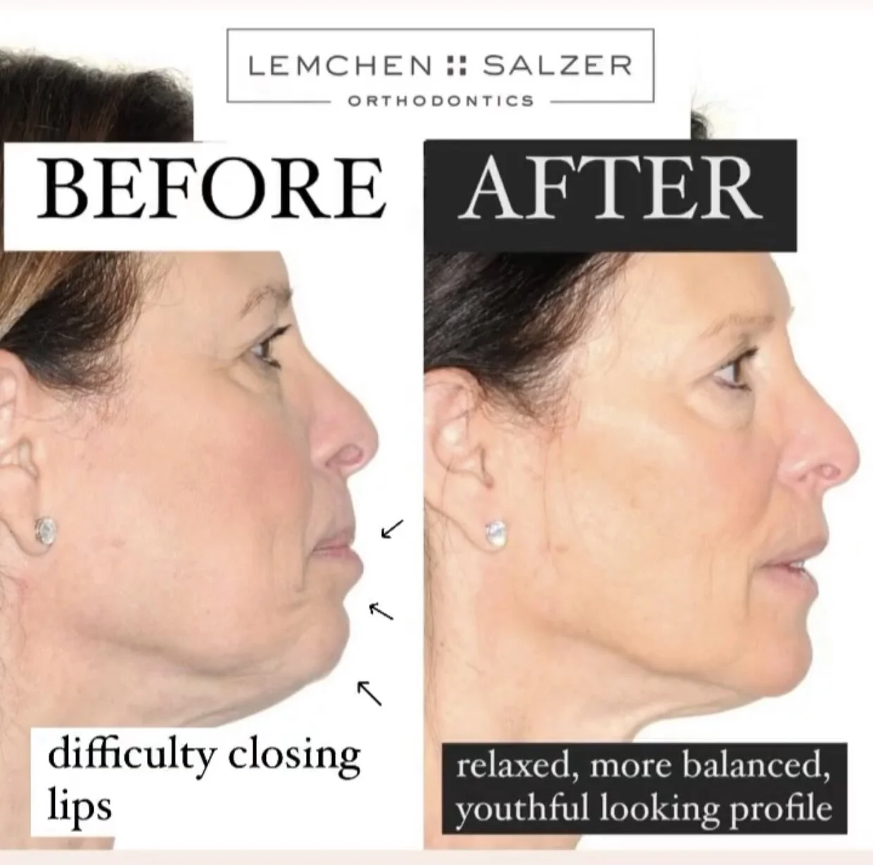 before &amp; after: a more balanced youthful looking profile