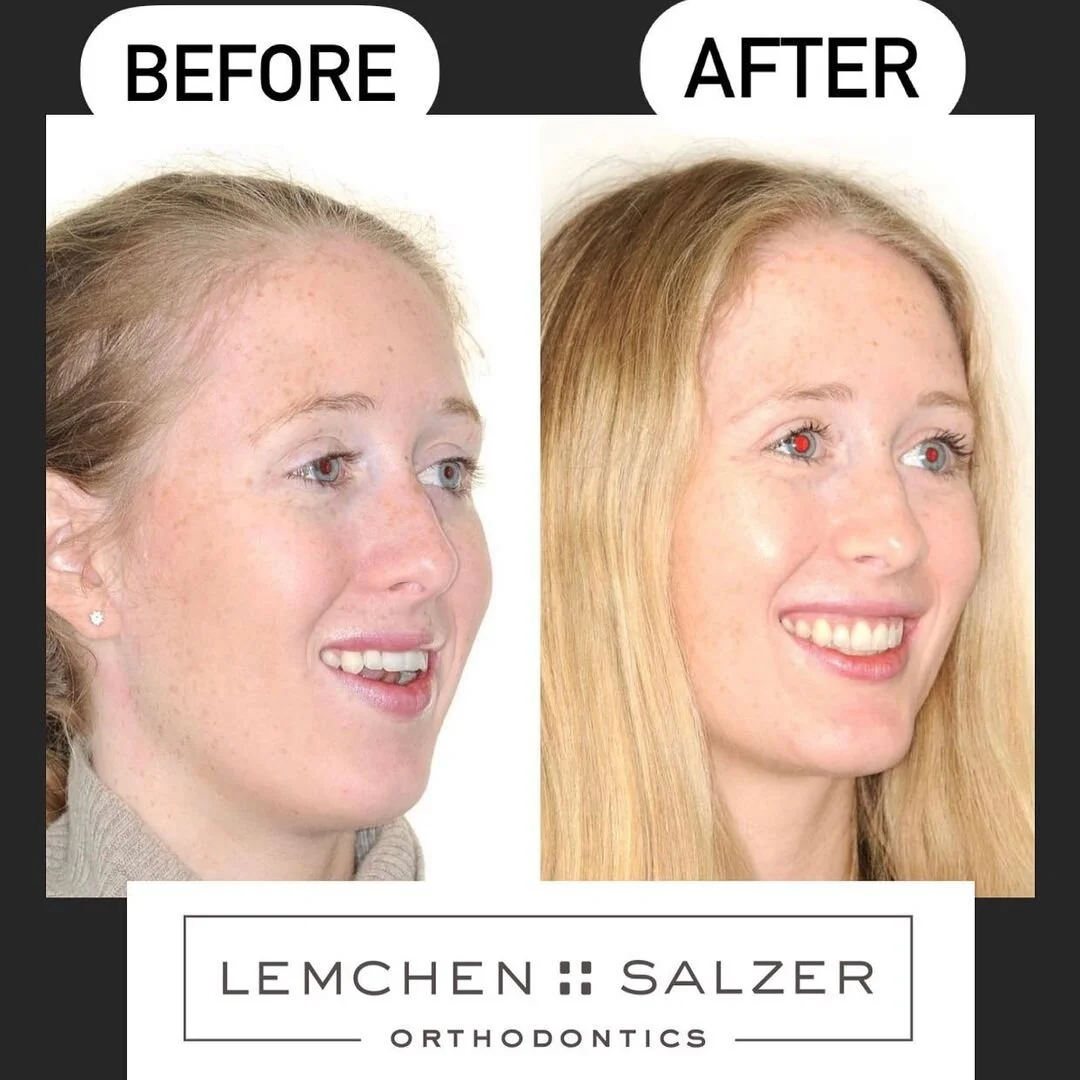 Exploring an Open Bite Case