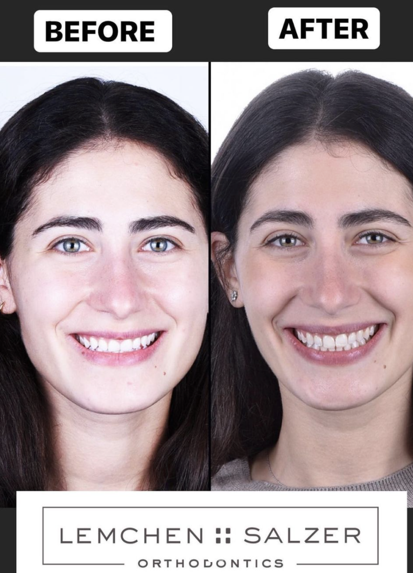 Before &amp; After: Dr. shapiro discusses the benefits of torque &amp; braces
