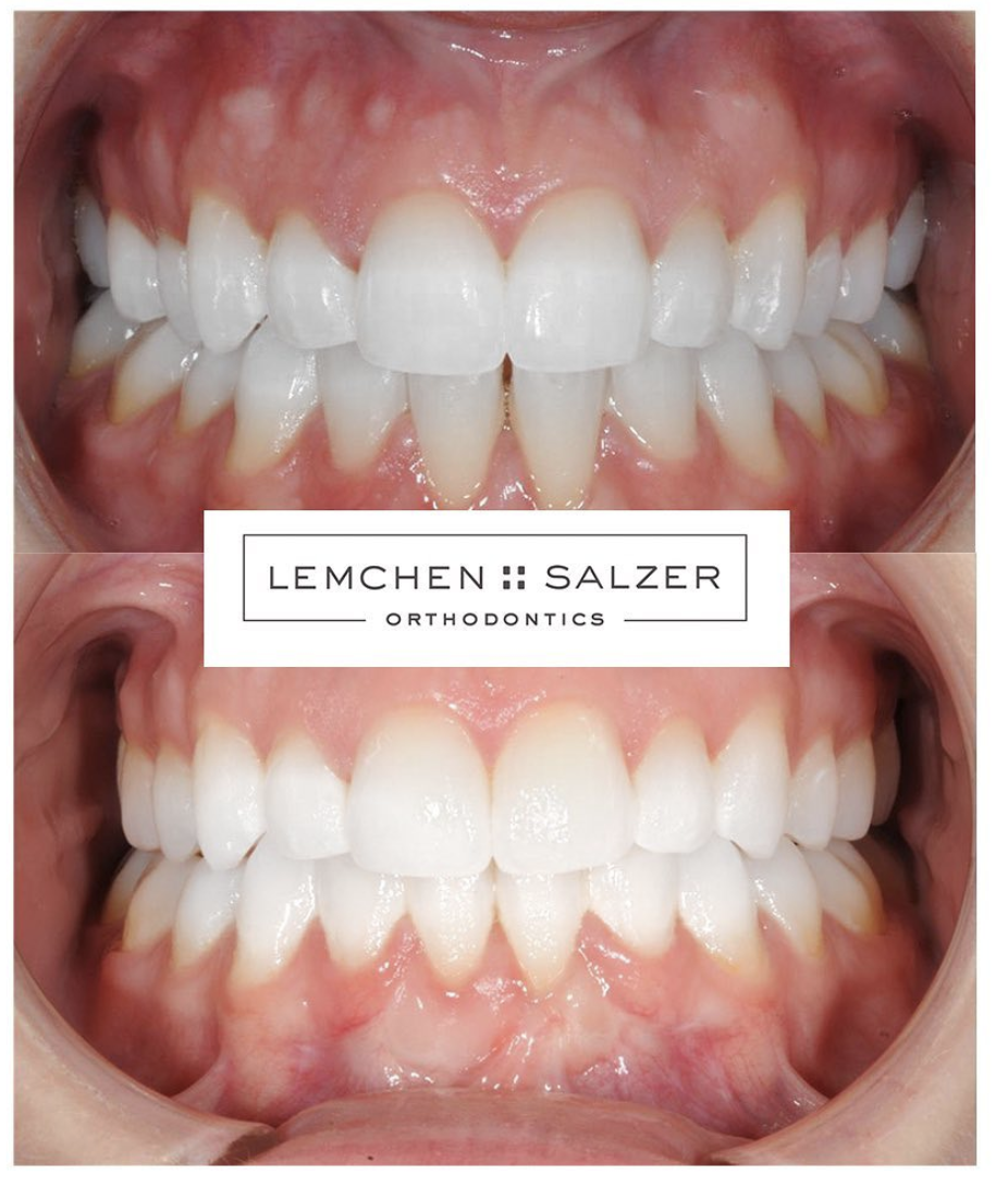 An Update on Genevieve's Smile...She's Not Afraid to Show Teeth Now!