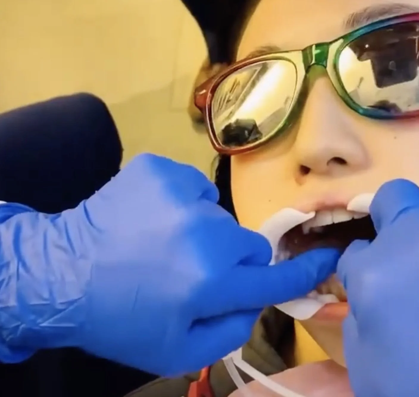 Here's a Look at What It's Like to Get Inbrace (Or Lingual / Inside Braces)!