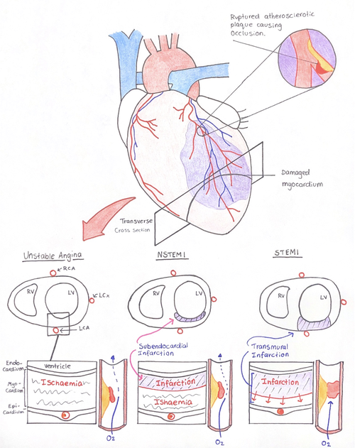 Figure 1:  Transverse cross sectional image of the heart, shows the differentiating pathophysiology between variants of ACS