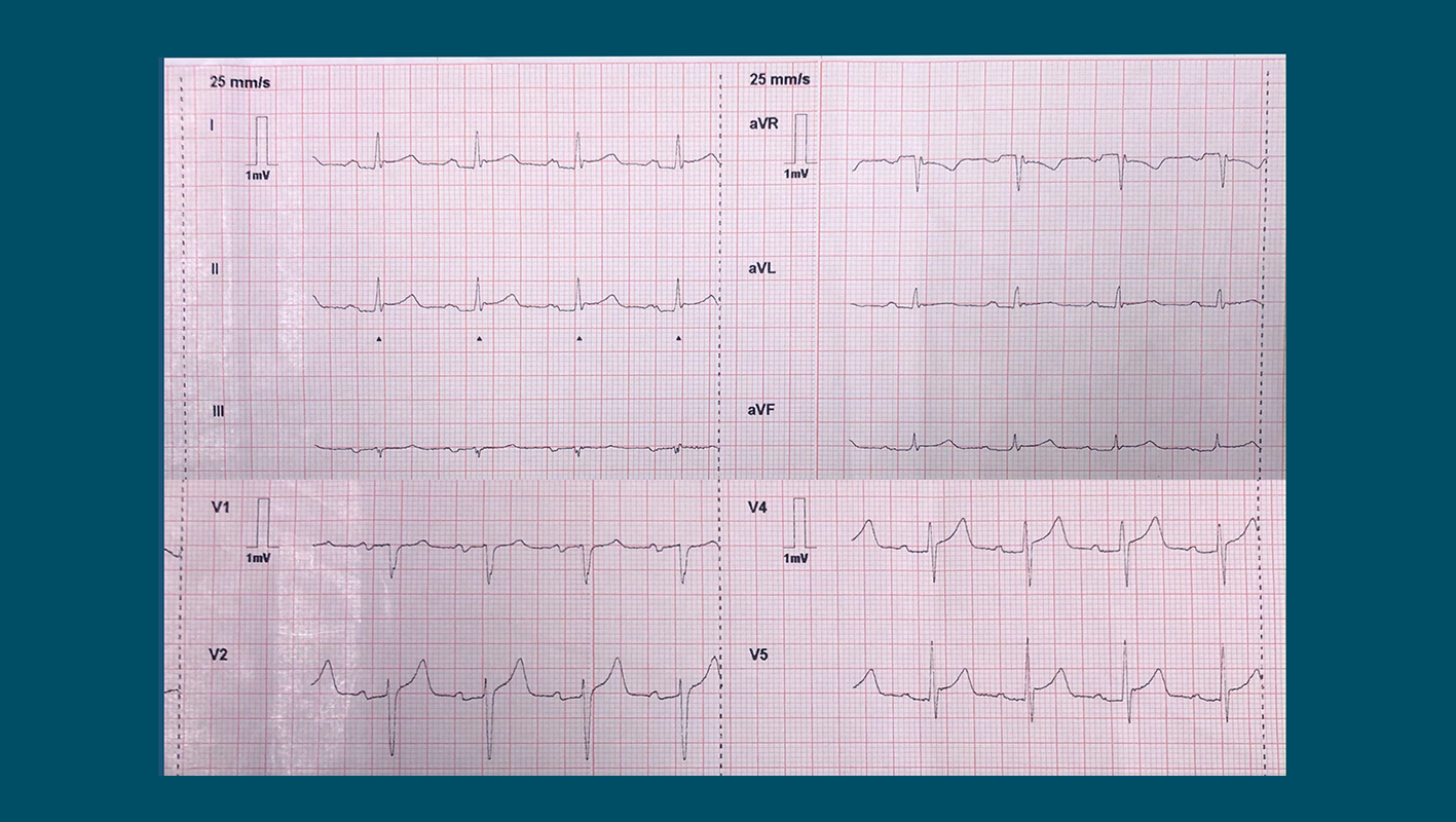 Acute Pericarditis Vs Stemi Ecg