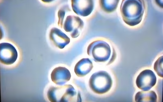 Rouleau formation is when red blood cells become sticky and start stacking up, making it harder for oxygen to reach the cells.