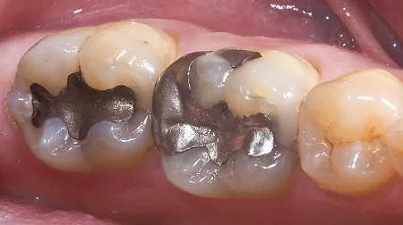 Amalgam is not stable after it is implanted into teeth. It constantly releases mercury vapor into your body. And this mercury bioaccumulates. photo: evolvedental.com.au